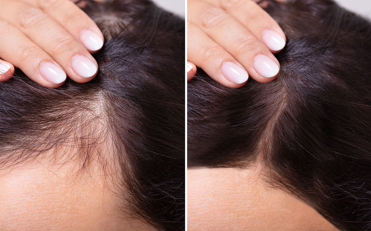 How to Stop Hair Loss